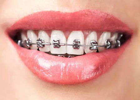 Orthodontics - Triple A Dental Clinic